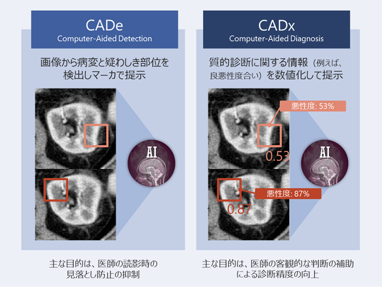 図4：コンピュータ診断支援（CAD）の分類と表示例
