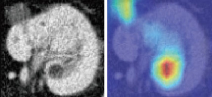 NTTデータAI画像診断ソリューションによる異常検出例（嚢胞）
