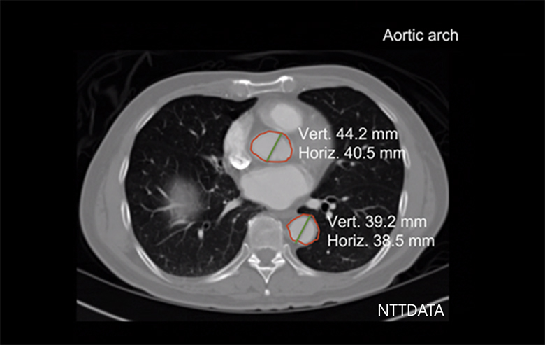 図3：画像診断AIの機能例（CT画像からの各臓器・部位のセグメンテーション：大動脈）